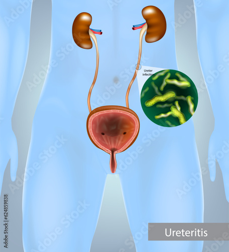 Ureteritis. Inflammation of the ureter. Ureter infection