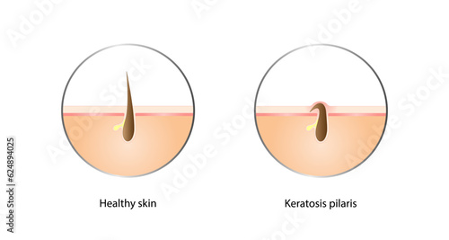 Keratosis pilaris, Ingrown hair, Chicken skin, Keratin plug and Bumpy skin. Hair has grown back into the skin. Difference between healthy skin, and follicular keratosis. Vector design.