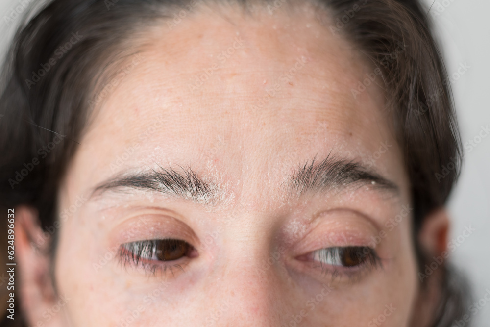psoriasis located on the eyebrows of a 40yearold Latin woman Stock