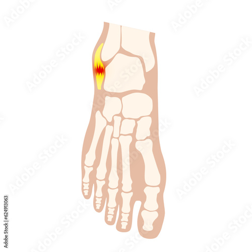 Sprained ankle injury