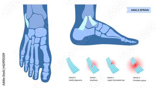 Sprained ankle injury