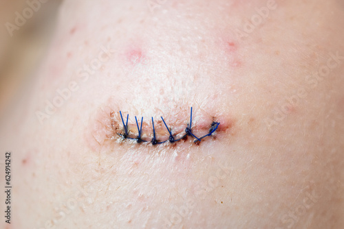 Sewn medical suture on human body
