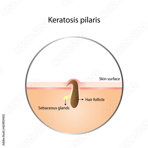 Keratosis pilaris, Ingrown hair, Chicken skin, Keratin plug and Bumpy skin. Hair has grown back into the skin. Difference between healthy skin, and follicular keratosis. Vector design.
