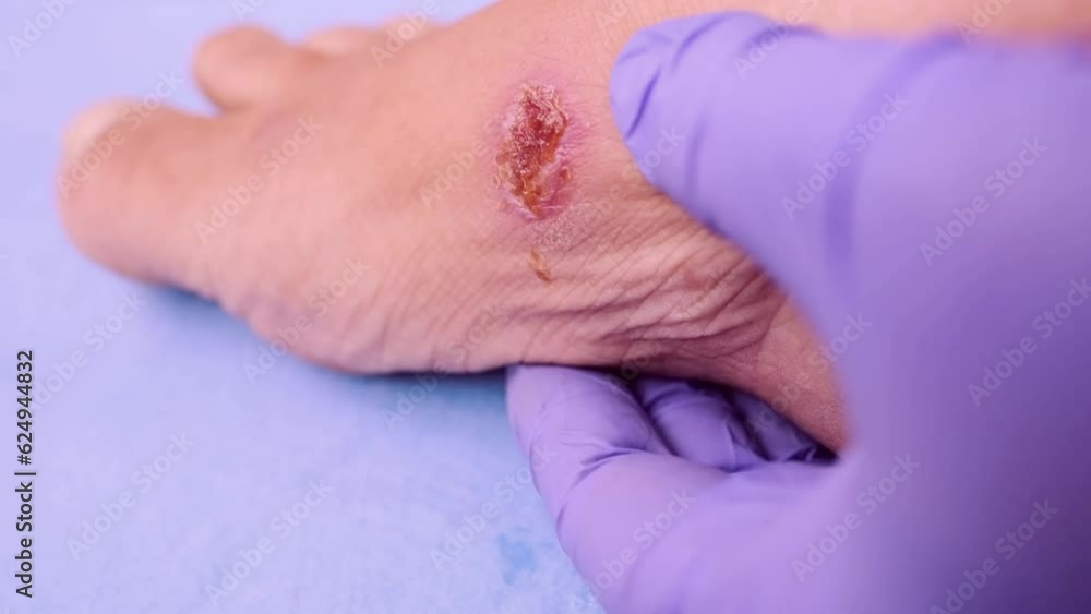 treatment weeping wound, trophic ulcer on female leg, wound exudate prevents healing ulcers by