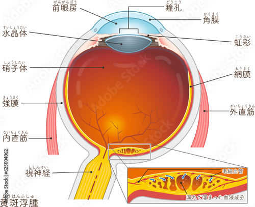 眼球・黄斑浮腫・macular edema・イラスト・eye・illustration