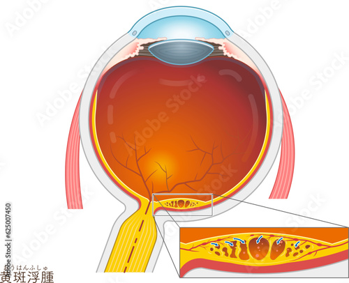眼球・黄斑浮腫・macular edema・イラスト・eye・illustration
