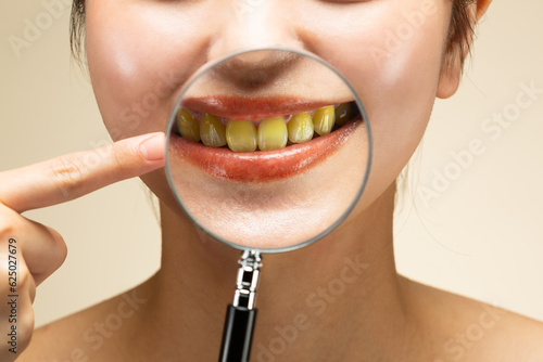 黄ばんだ歯をルーペで拡大している。 photo