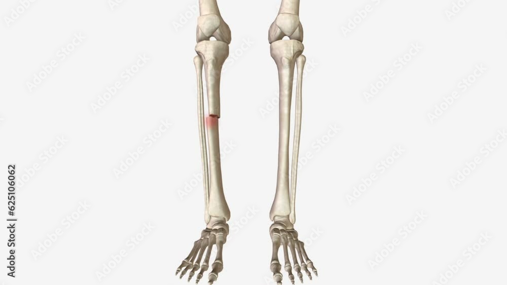 open fracture, also called a compound fracture, is a fracture in which there is an open wound or break in the skin near the site of the broken bone open fracture, also called a compound fracture, is a fracture in which there is an open wound or break in the skin near the site of the broken bone