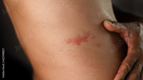 Man with shingles disease, skin infected with Herpes zoster, virus, Healthcare and medical.