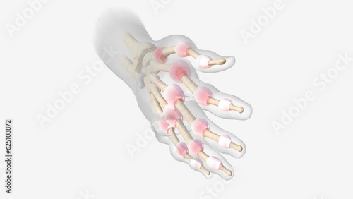 Advanced Rheumatoid Arthritis