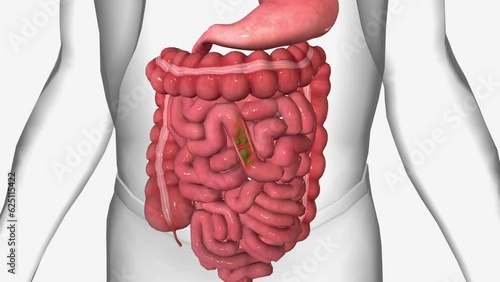 Diarrhea is when your stools are loose and watery. You may also need to go to the bathroom more often