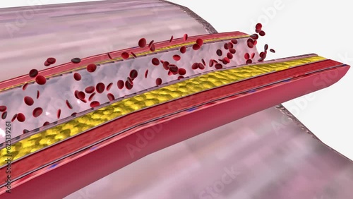Atherosclerosis Progression in the Penis Plaque photo