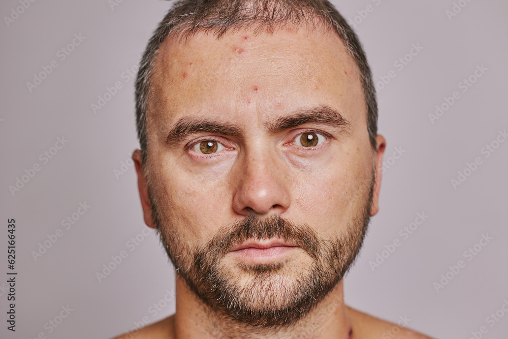 Man's forehead with acne, red spots, skin disease Man's forehead with acne, red spots, skin disease
