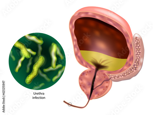 Urethritis is the inflammation of the urethra. Urinary tract infection. Gonococcal urethritis