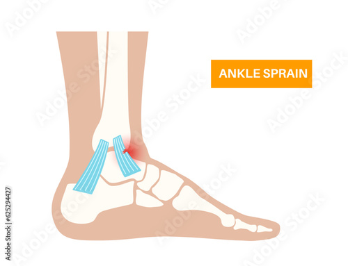 Sprained ankle injury