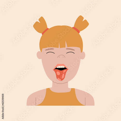 The girl shows the geographical tongue. Symptom of stomatitis, candidiasis, allergies. Vector illustration in flat style