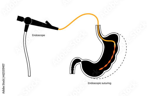 Endoscopic sleeve gastroplasty