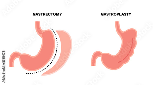 Gastrectomy and gastroplasty