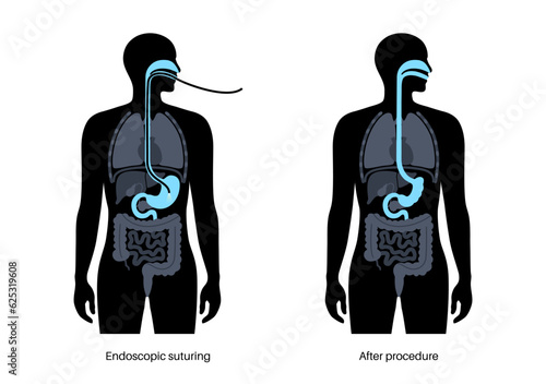 Endoscopic sleeve gastroplasty