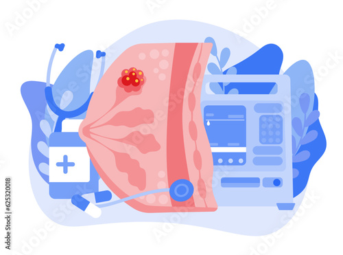 The concept of breast cancer. A malignant tumor develops in the human mammary gland. The structure of a cancer cell. flat vector illustration