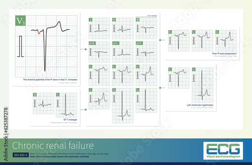 Common ECG changes in chronic renal insufficiency include left ventricular hypertrophy, left atrial abnormality, poor R wave progression and ST-T changes. photo