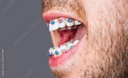 Bracket system in smiling mouth, macro photo teeth, close-up lips, macro shot, dentist. Man braces. Teeth braces on the white teeth of man to equalize the teeth