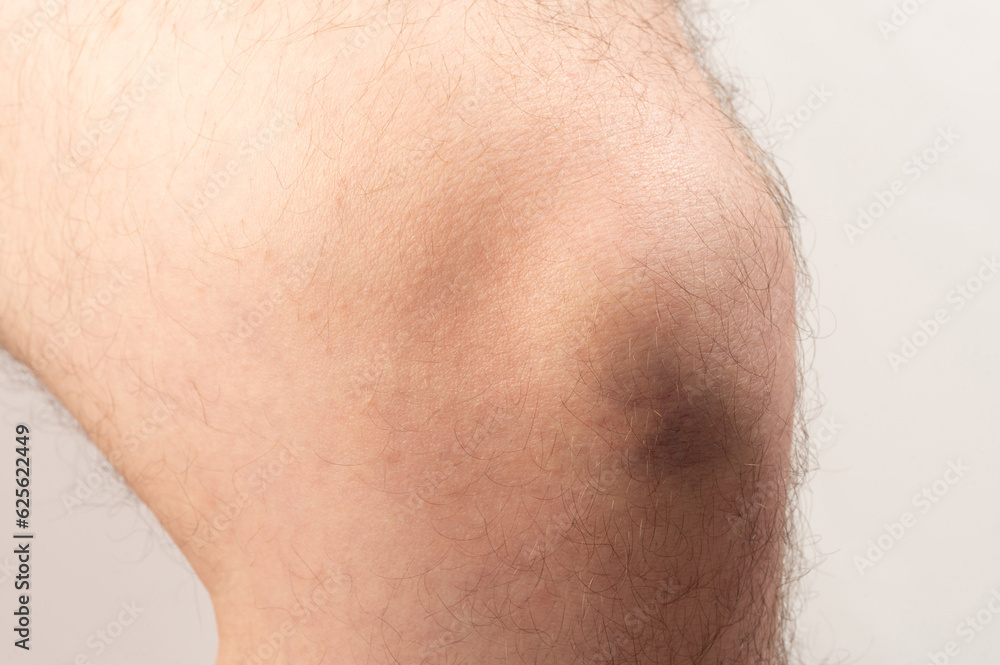 Dark color bruise on knee Dark color bruise on knee