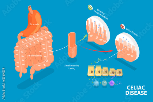 3D Isometric Flat Vector Conceptual Illustration of Celiac Disease, Educational Diagram photo