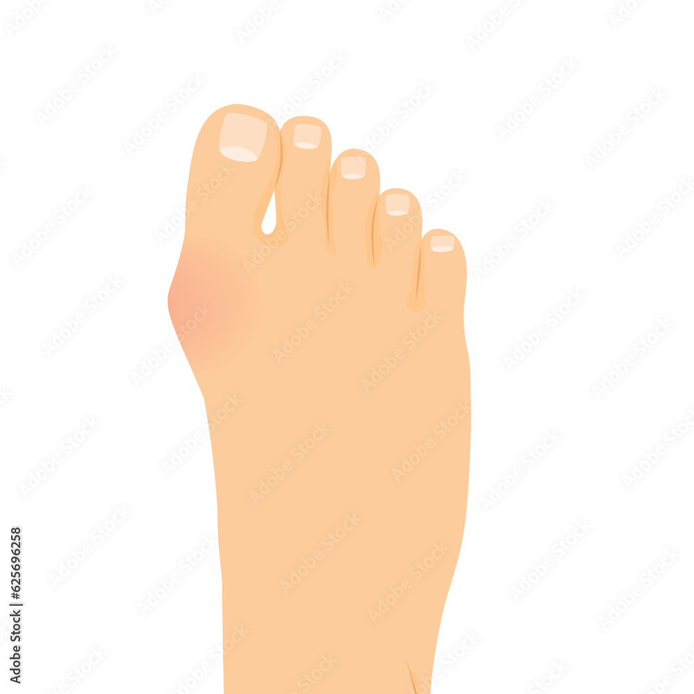 foot with hallux valgus, bunion, deformitie of big toe joint - vector illustration foot with hallux valgus, bunion, deformitie of big toe joint - vector illustration