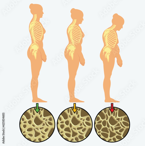 Osteoporosis - the progression of osteoporosis and vertebral fractures as a woman ages. photo