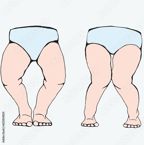 baby leg structure, straight crisscross