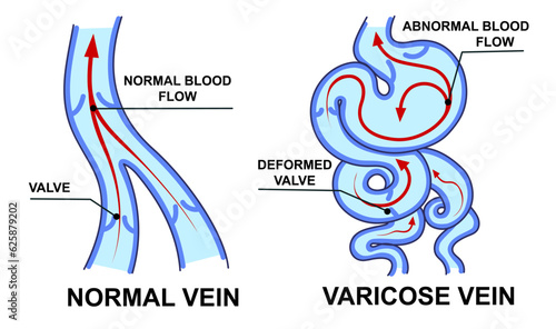 Normal vein. Varicose vein. Blood flow. Vector illustration. Healthcare illustration. 