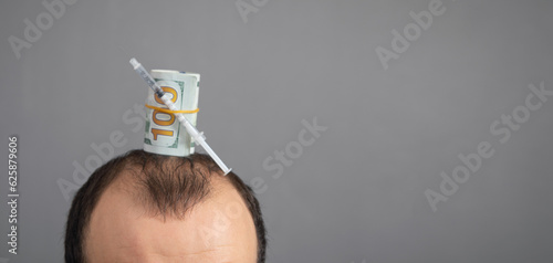 Caucasian man with a syringe and money. Money for hair transplantation. Hair loss problem