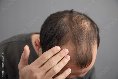 Caucasian man. Hair loss problem