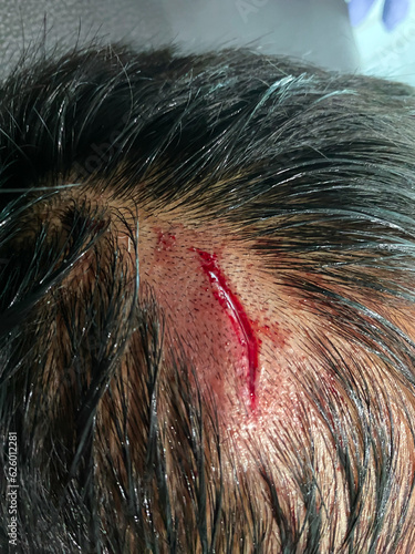 The lacerated wound as a result of impact with a sharp object