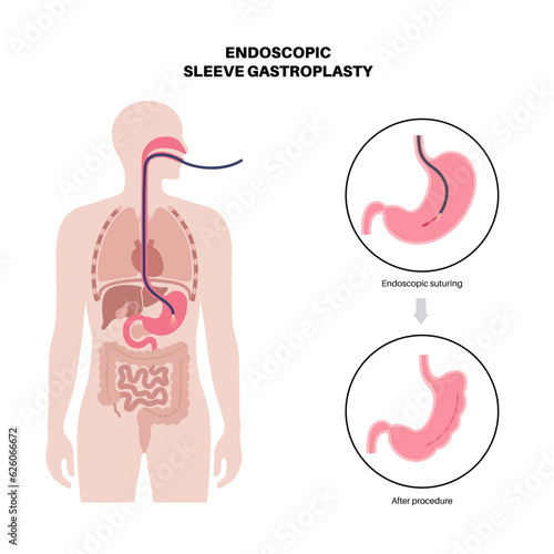Endoscopic sleeve gastroplasty