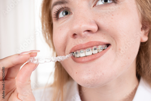 Dental care.Smiling girl with braces on her teeth holds aligners in her hands and shows the difference between them