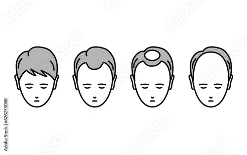 AGA、脱毛症が進行する男性のイラスト
