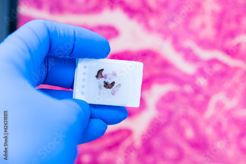 Canvas Print Scientist wear blue glove holding parafin human tissue block and out of focus computer monitor show glandular image