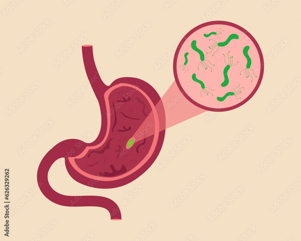 Fototapeta premium Stomach disease Helicobacter Pilori disease in human Stomach