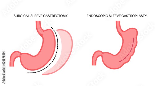 Gastrectomy and gastroplasty