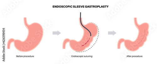 Endoscopic sleeve gastroplasty