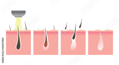 Laser hair removal illustration. Ipl hair follicle removal icon step. Before and after use laser. Process of hair removal by laser. Vector illustration