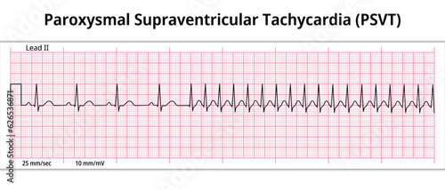 ECG Paroxysmal Supraventricular Tachycardia (PSVT) - 8 Second ECG Paper - Electrocardiogram Vector Medical Illustration