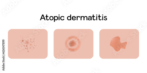 Atopic dermatitis examples vector illustration design, medical problems