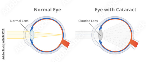 Anatomical vector scheme or illustration of a normal healthy eye and eye with cataract or cataract eye isolated on white. Cloudy area in the lens, clouding of the lens. Eye vision disorder.