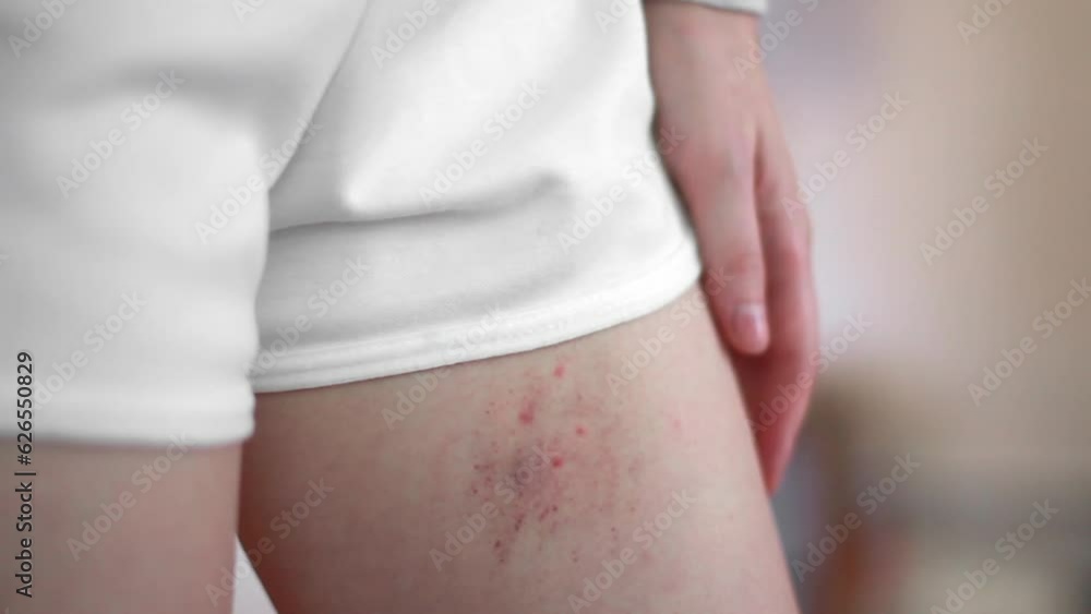 A woman was bitten by an insect on the leg close-up. Consequences of ...