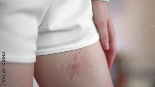 A woman was bitten by an insect on the leg close-up. Consequences of insect bites. Allergic reaction from the bite.
