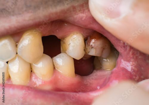 Fotografie Missing teeth and dental problems in a caucasian man close-up