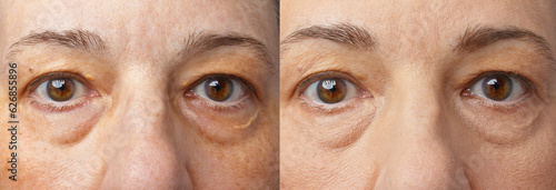 Xanthelasma on all 4 eyelids of a 55 years old woman, before and after applying camouflage make-up on lower and eye shadow on the spots of upper lids. photo